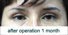 plastic-surgery-blepharoplasty